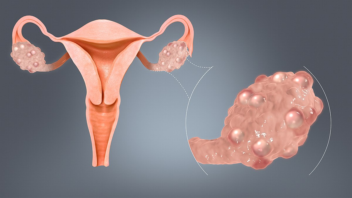 PCOS Awareness Month: Understanding Polycystic Ovarian Syndrome and Navigating Life with It