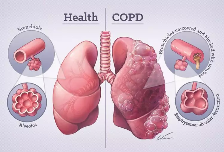 COPD Awareness: Understanding the “Silent” Respiratory Condition