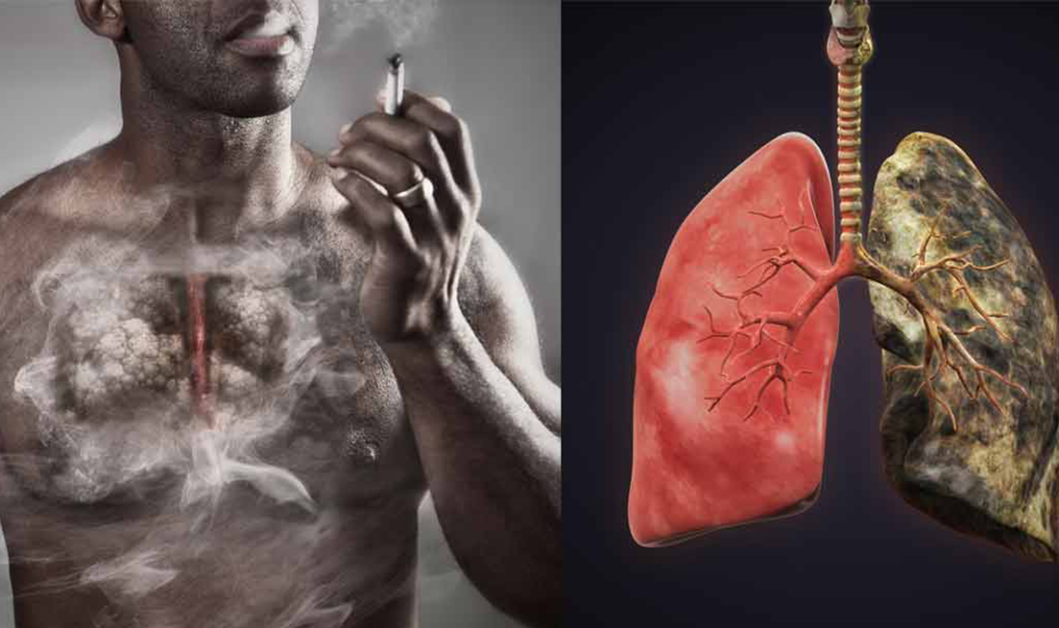 COPD Awareness: Understanding the “Silent” Respiratory Condition